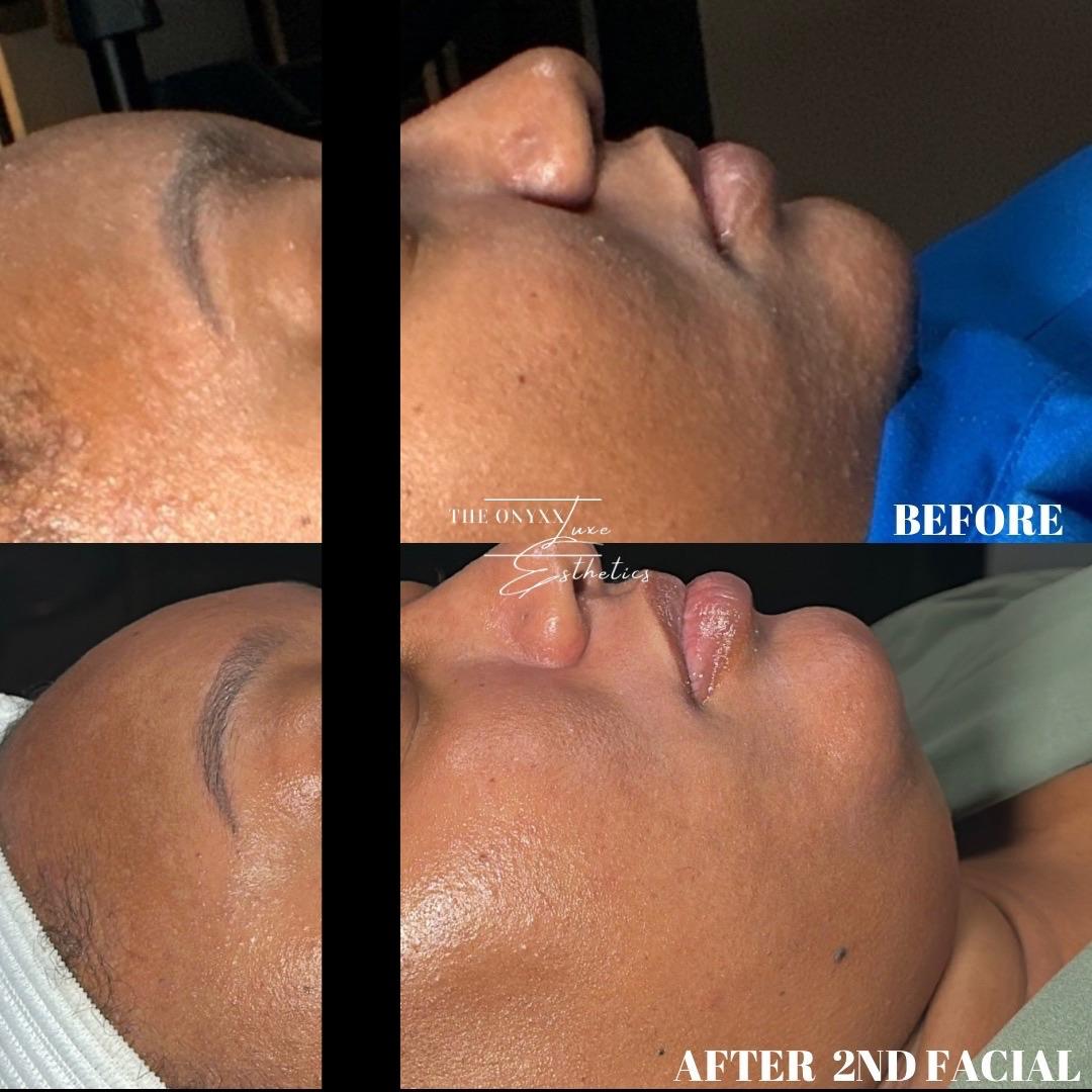 Facial